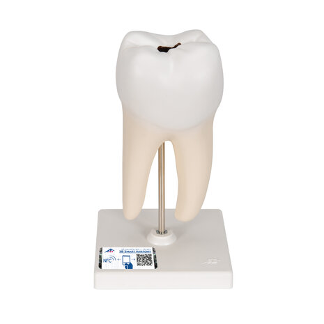 Anatomie model ondermolaar met cari&euml;s, 29 cm