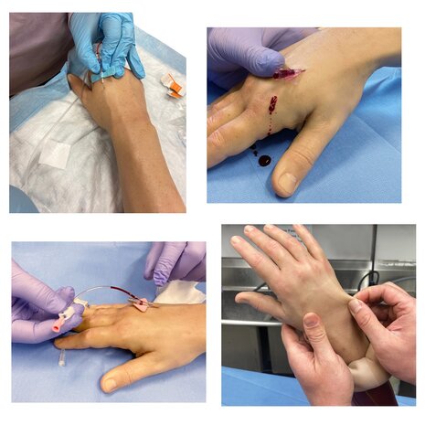 Injectie infuus model arm/hand