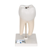 Anatomie model ondermolaar met cariës, 29 cm