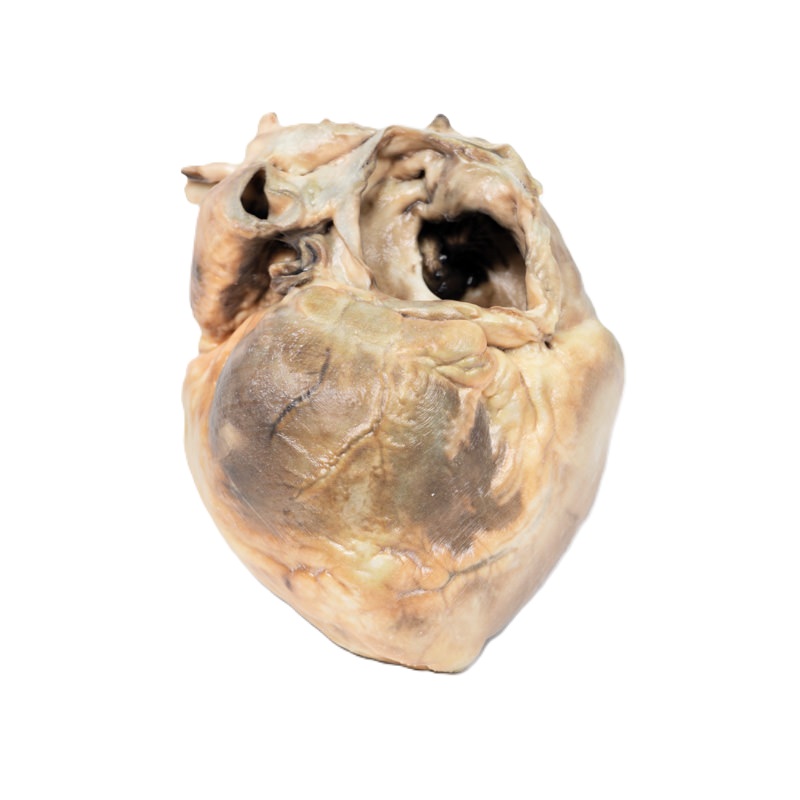 Erler-Zimmer Atriumseptumdefect (ASD) Anatomiemodel 3D