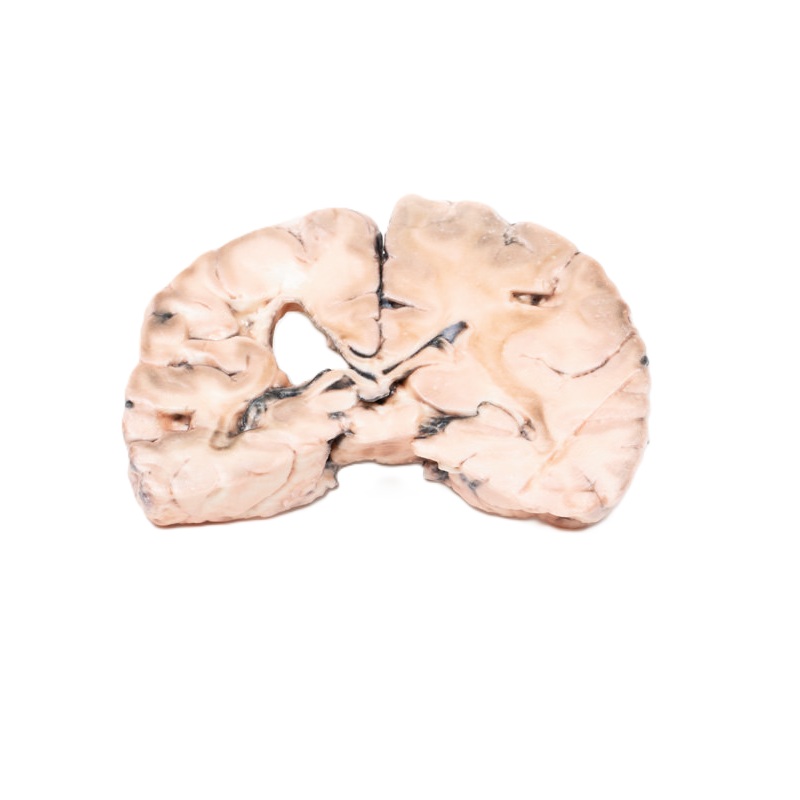 Linker herseninfarct