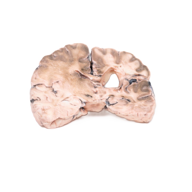 Linker herseninfarct
